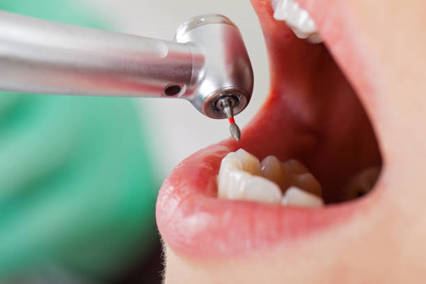 Best Broken or Cracked Tooth Emergency Dentist in Athens, IL